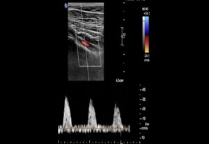 Lee más sobre el artículo Doppler Arterial de MMII